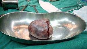 Nữ sinh 18 tuổi mắc bệnh viêm não hiếm gặp