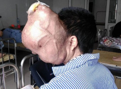 Kinh hãi khối u khổng lồ ăn dần não của người đàn ông