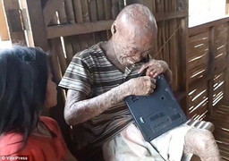 Căn bệnh lạ khiến người đàn ông trông như 'quỷ dữ', bị mọi người xua đuổi