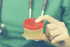Nước tiểu sậm màu có thể là dấu hiệu của... ung thư?