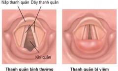 Suýt chết do ngạt thở vì hóc xương cá mà không đi khám
