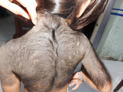 Xót xa bé gái ở Cà Mau mắc bệnh lạ, lông đen rậm như người sói