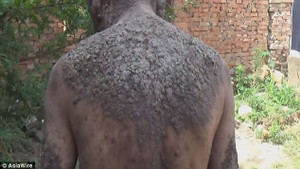 Gặp 'người cây' mắc bệnh lạ, toàn thân đóng vảy đáng sợ