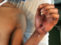 Mổ ghép thành công đôi tay bị chém đứt lìa cho chàng trai trẻ