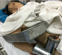 Người phụ nữ cấp cứu với bàn tay nằm trong máy xay thịt