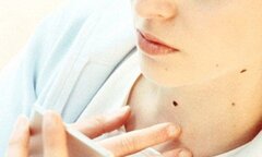 Nếu có nốt ruồi này, bạn phải đi khám ung thư ngay tức khắc