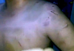 Phẫn nộ bé trai 9 tuổi bị mẹ đánh đập bầm tím cơ thể