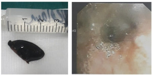 Mắc hạt hồng xiêm trong phế quản, 3 năm sau mới phát hiện