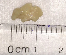 Hy hữu: Viêm phổi nặng do miếng thịt rơi vào khi sặc lẩu