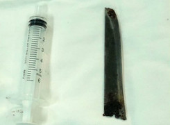 Choáng với lưỡi dao 12cm nằm trong lưng bệnh nhân nhiều năm nhưng không biết