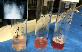 Ho ra máu lúc 4 tuổi, 9 năm sau mới phát bệnh hiếm gặp
