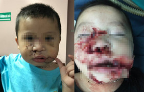 Phẫu thuật tạo hình thành công cho bé trai 21 tháng tuổi bị chó cắn nát mặt