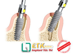 Trả lại hàm răng đầy đủ với công nghệ Cấy Ghép Răng Implant ETK Active