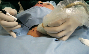 Điều trị bướu nhân tuyến giáp bằng sóng cao tần