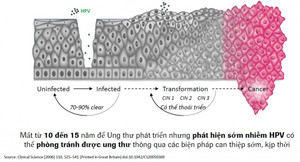 HPV DNA: Xét nghiệm đầu tay trong tầm soát ung thư cổ tử cung được ứng dụng rộng rãi trên toàn cầu