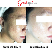 Khách hàng nói gì về liệu trình điều trị mụn tại Seoul Spa?