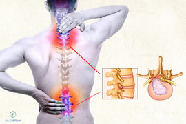 7 triệu chứng thoát vị đĩa đệm điển hình theo bác sĩ Nguyễn Bá Vưỡng