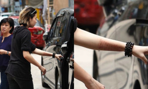 Con gái Thành Long lộ chi chít vết cứa trên tay sau khi xuất viện