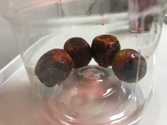 4 viên sỏi to như quả mận trong túi mật người đàn ông 61 tuổi