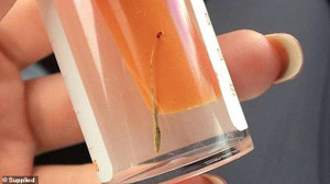 Kỳ lạ: Cỏ mọc dài 3cm trong tai thiếu nữ