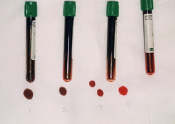 Bí ẩn dòng họ duy nhất thế giới có làn da màu xanh da trời