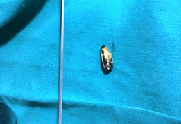 Hóc hạt hướng dương, bé trai suýt mất mạng