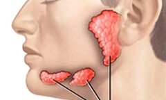 Xuất hiện dấu hiệu này bạn nên nghĩ đến ung thư tuyến nước bọt