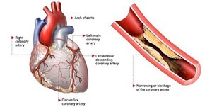 Thủ phạm gây nhồi máu cơ tim