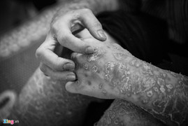 Trầm cảm, tự tử vì không chịu được áp lực khi mắc bệnh vảy nến