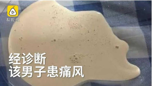 Uống bia từ 10 tuổi, dịch màu trà sữa đầy trong khớp gối