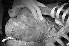 Người phụ nữ mang khối u nặng 4,1kg trong bụng suốt 2 năm