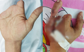 Nam thanh niên cắt ngón chân ghép vào bàn tay bị cụt