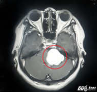 Hi hữu: Tách thành công khối u màng não to bằng quả bóng bàn ra khỏi đầu bệnh nhân