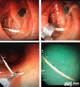 Hy hữu: Cụ bà suýt thủng ruột vì cây tăm tre rơi trong bụng