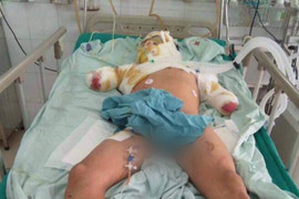 Gia cảnh khốn khó của nam thanh niên phải cắt bỏ 2 cánh tay khi giúp hàng xóm sửa điện