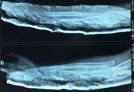 Tội nghiệp cháu bé bị chân vịt máy ghe chém nát tay