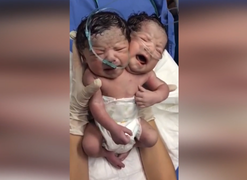 Em bé chào đời có 2 đầu