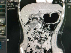 Đau bụng dữ dội, bé trai 12 tuổi nhập viện vì bệnh lạ hiếm gặp