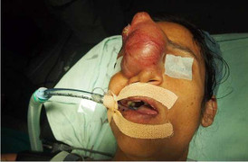 Cô gái lần đầu tiên được hôn chồng nhờ phẫu thuật cắt khối u trên mặt