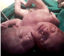 Em bé có 2 đầu tử vong sau vài giờ chào đời