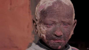 Thương xót cậu bé 11 tuổi 'hóa' xác ướp vì căn bệnh hiếm gặp