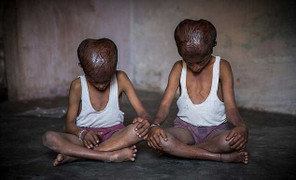 Y học bó tay với hai cậu bé trông già như ông lão 80