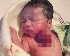 Cha mẹ chết ngất khi thấy tim con nằm ngoài cơ thể