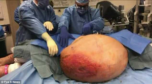 Cụ bà 71 tuổi lấy lại vóc dáng gợi cảm sau khi cắt bỏ khối u buồng trứng nặng 63kg