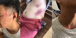 Người đàn ông dính đa chấn thương sau khi bị tạm giữ ở Phú Quốc