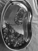 Ăn nhiều mỳ tôm và đồ ăn sẵn, cô gái bị kết 100 viên sỏi trong túi mật