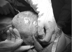 Phẫu thuật lấy khối u nặng 2,6 kg trong khoang màng phổi