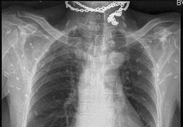 Hãi hùng cảnh sán dây 'dạo chơi' khắp người do ăn tiết canh