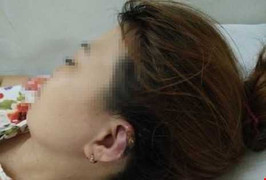 Suýt mất vành tai và tóc vì đi làm đẹp ở tiệm uốn tóc