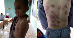 Nghi vấn bé trai 10 tuổi tố bị sư trụ trì đánh thâm tím cơ thể